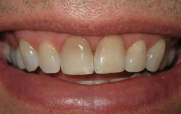 Teeth Discoloration Home Remedy Free Windows Software Torrent License Cracked .rar