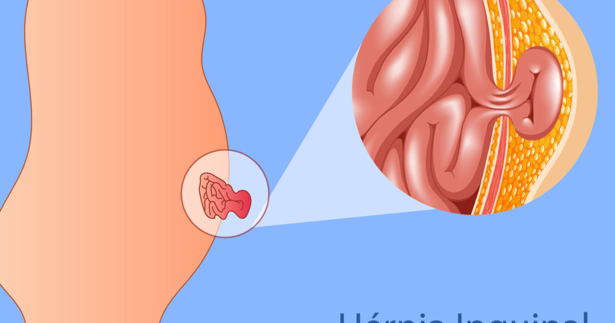 Hérnia inguinal em Hospital Dia - Amato