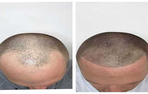 Male Pattern Baldness: Why Early Care Is Important for Hair Health